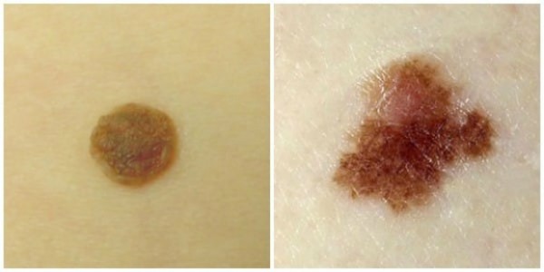 Sự căn đối của nốt ruồi có liên quan đến ung thư da.
